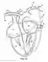 Fig. 14 - Method for increasing blood flow in or about a cardiac or other vascular or prosthetic structure to prevent thrombosis