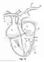 Fig. 15 - Method for increasing blood flow in or about a cardiac or other vascular or prosthetic structure to prevent thrombosis