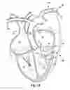 Fig. 16 - Method for increasing blood flow in or about a cardiac or other vascular or prosthetic structure to prevent thrombosis