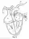 Fig. 17 - Method for increasing blood flow in or about a cardiac or other vascular or prosthetic structure to prevent thrombosis
