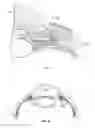 Fig. 02 - Ocular implant with stiffness qualities, methods of implantation and system