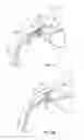 Fig. 11 - Ocular implant with stiffness qualities, methods of implantation and system