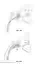 Fig. 12 - Ocular implant with stiffness qualities, methods of implantation and system