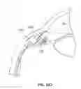 Fig. 13 - Ocular implant with stiffness qualities, methods of implantation and system