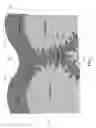 Fig. 04 - Combined modality treatment systems, methods and apparatus for body contouring applications