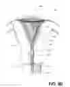 Fig. 12 - Methods and systems for endometrial ablation