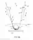 Fig. 04 - Flexible tissue removal devices and methods