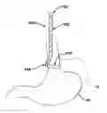 Fig. 01 - METHODS AND DEVICES FOR PLACEMENT OF AN INTRA-ABDOMINAL OR INTRA-THORACIC APPLIANCE THROUGH A NATURAL BODY ORIFICE