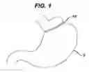 Fig. 02 - METHODS AND DEVICES FOR PLACEMENT OF AN INTRA-ABDOMINAL OR INTRA-THORACIC APPLIANCE THROUGH A NATURAL BODY ORIFICE