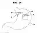 Fig. 06 - METHODS AND DEVICES FOR PLACEMENT OF AN INTRA-ABDOMINAL OR INTRA-THORACIC APPLIANCE THROUGH A NATURAL BODY ORIFICE