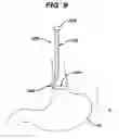 Fig. 09 - METHODS AND DEVICES FOR PLACEMENT OF AN INTRA-ABDOMINAL OR INTRA-THORACIC APPLIANCE THROUGH A NATURAL BODY ORIFICE