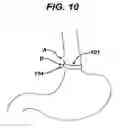 Fig. 10 - METHODS AND DEVICES FOR PLACEMENT OF AN INTRA-ABDOMINAL OR INTRA-THORACIC APPLIANCE THROUGH A NATURAL BODY ORIFICE