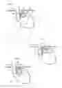 Fig. 02 - Apparatus for treating GERD