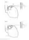 Fig. 06 - Apparatus for treating GERD