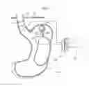 Fig. 34 - Apparatus for treating GERD