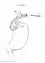Fig. 44 - Apparatus for treating GERD