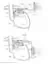 Fig. 60 - Apparatus for treating GERD