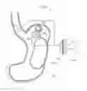 Fig. 61 - Apparatus for treating GERD