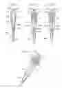 Fig. 92 - Apparatus for treating GERD