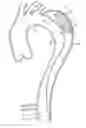 Fig. 01 - False lumen occluder