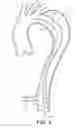 Fig. 09 - False lumen occluder