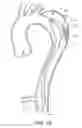 Fig. 10 - False lumen occluder