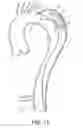 Fig. 11 - False lumen occluder
