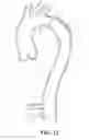 Fig. 12 - False lumen occluder