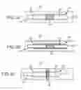 Fig. 04 - Devices and methods for treating venous diseases
