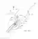 Fig. 24 - Systems and methods for treating septal defects