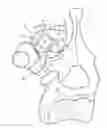 Fig. 01 - Bone fixing system and method of use