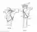 Fig. 15 - Bone fixing system and method of use
