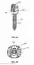 Fig. 03 - SPINAL FIXATION SYSTEM