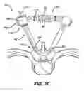 Fig. 20 - Minimally invasive spinal fixation guide systems and methods
