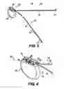Fig. 04 - Obstructive Sleep Apnea Treatment Devices, Systems and Methods