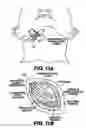 Fig. 09 - Obstructive Sleep Apnea Treatment Devices, Systems and Methods