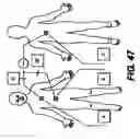 Fig. 40 - Obstructive Sleep Apnea Treatment Devices, Systems and Methods