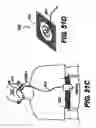 Fig. 44 - Obstructive Sleep Apnea Treatment Devices, Systems and Methods