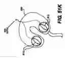 Fig. 48 - Obstructive Sleep Apnea Treatment Devices, Systems and Methods
