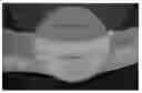 Fig. 01 - PROSTHETIC DEVICE AND METHOD OF USING IN BREAST AUGMENTATION AND/OR BREAST RECONSTRUCTION