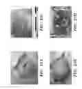 Fig. 22 - PROSTHETIC DEVICE AND METHOD OF USING IN BREAST AUGMENTATION AND/OR BREAST RECONSTRUCTION