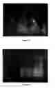 Fig. 09 - Implantable medical device including surface geometry having reduced biofilm formation characteristics