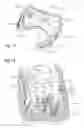 Fig. 08 - Methods of using a particle impact drilling system for removing near-borehole damage, milling objects in a wellbore, under reaming, coring, perforating, assisting annular flow, and associated methods
