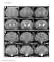 Fig. 07 - Methods for distributing high levels of therapeutic agent throughout the cortex to treat neurological disorders