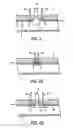 Fig. 05 - Apparatus for sealing a puncture by causing a reduction in the circumference of the puncture
