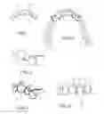 Fig. 02 - Dental splint device and methods for making and using same
