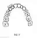 Fig. 07 - Dental splint device and methods for making and using same