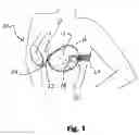 Fig. 02 - CLEAVAGE ENHANCING BRA SYSTEM