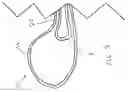 Fig. 04 - CLEAVAGE ENHANCING BRA SYSTEM