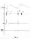 Fig. 02 - PULSE DETECTION APPARATUS, SOFTWARE, AND METHODS USING PATIENT PHYSIOLOGICAL SIGNALS
